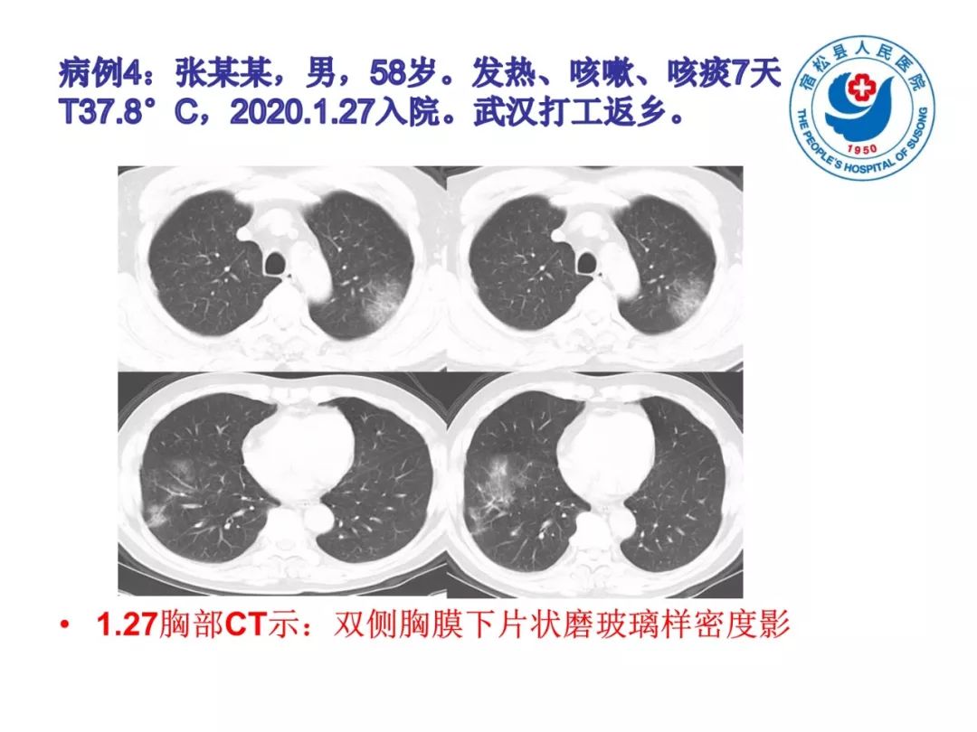 【PPT】(来自一个县医院的12例)我院新型冠状病毒肺炎特点