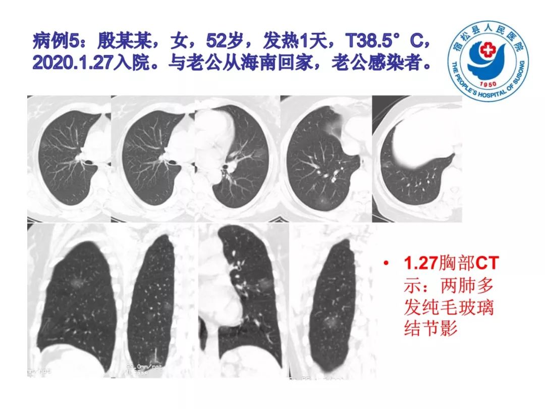 【PPT】(来自一个县医院的12例)我院新型冠状病毒肺炎特点