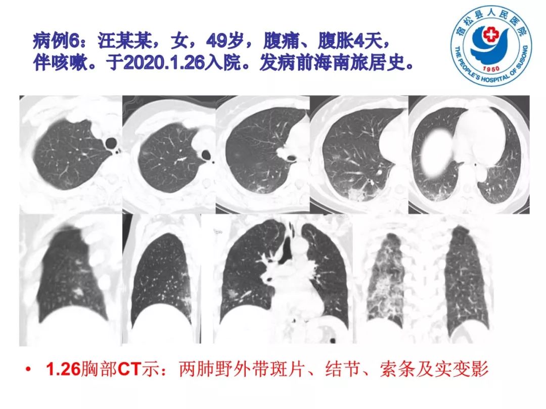 【PPT】(来自一个县医院的12例)我院新型冠状病毒肺炎特点