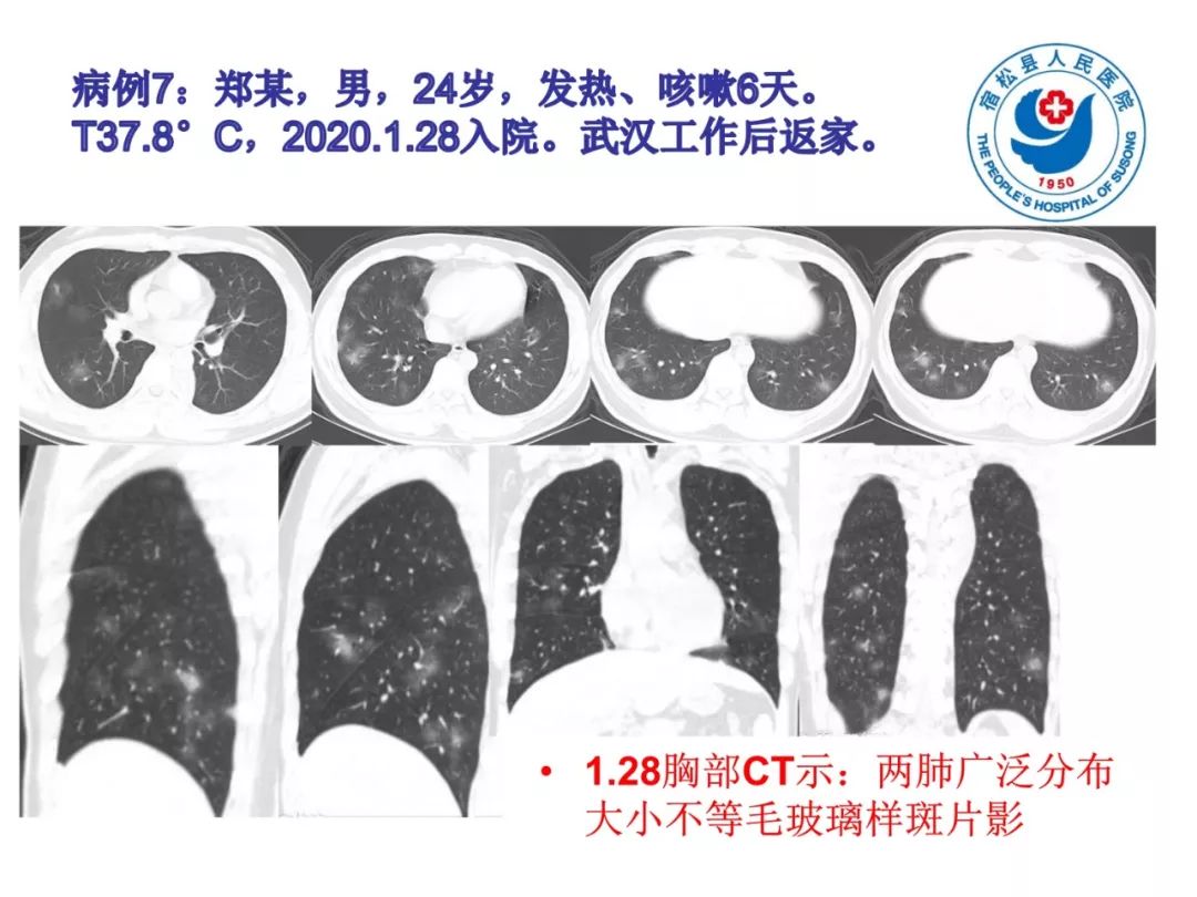 【PPT】(来自一个县医院的12例)我院新型冠状病毒肺炎特点