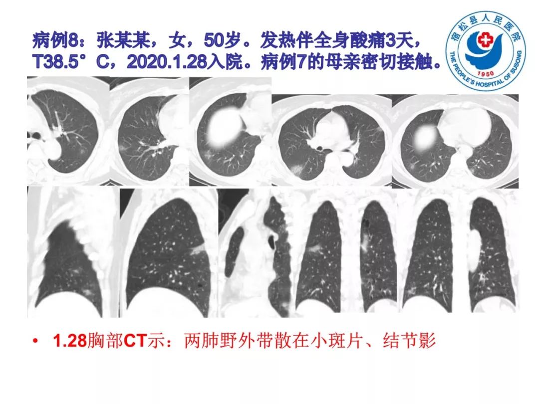 【PPT】(来自一个县医院的12例)我院新型冠状病毒肺炎特点