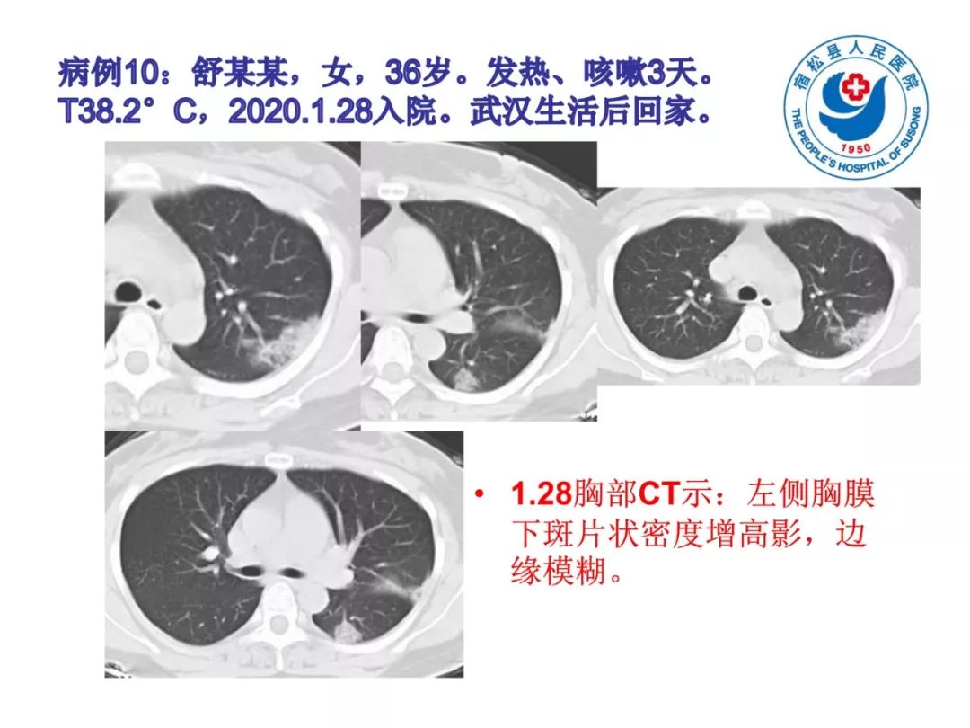 【PPT】(来自一个县医院的12例)我院新型冠状病毒肺炎特点