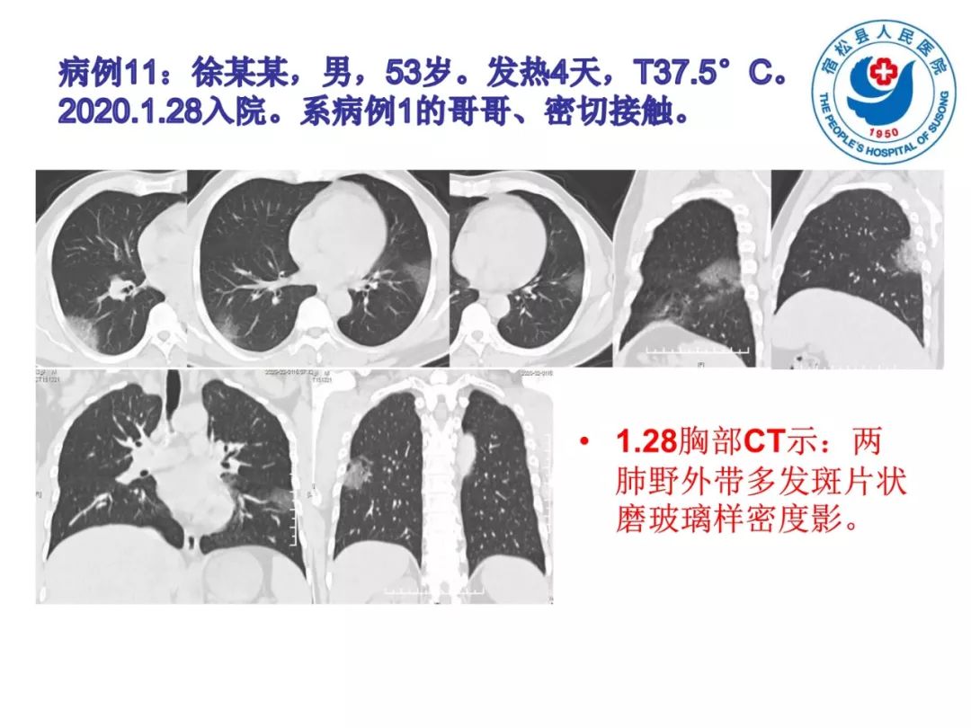 【PPT】(来自一个县医院的12例)我院新型冠状病毒肺炎特点