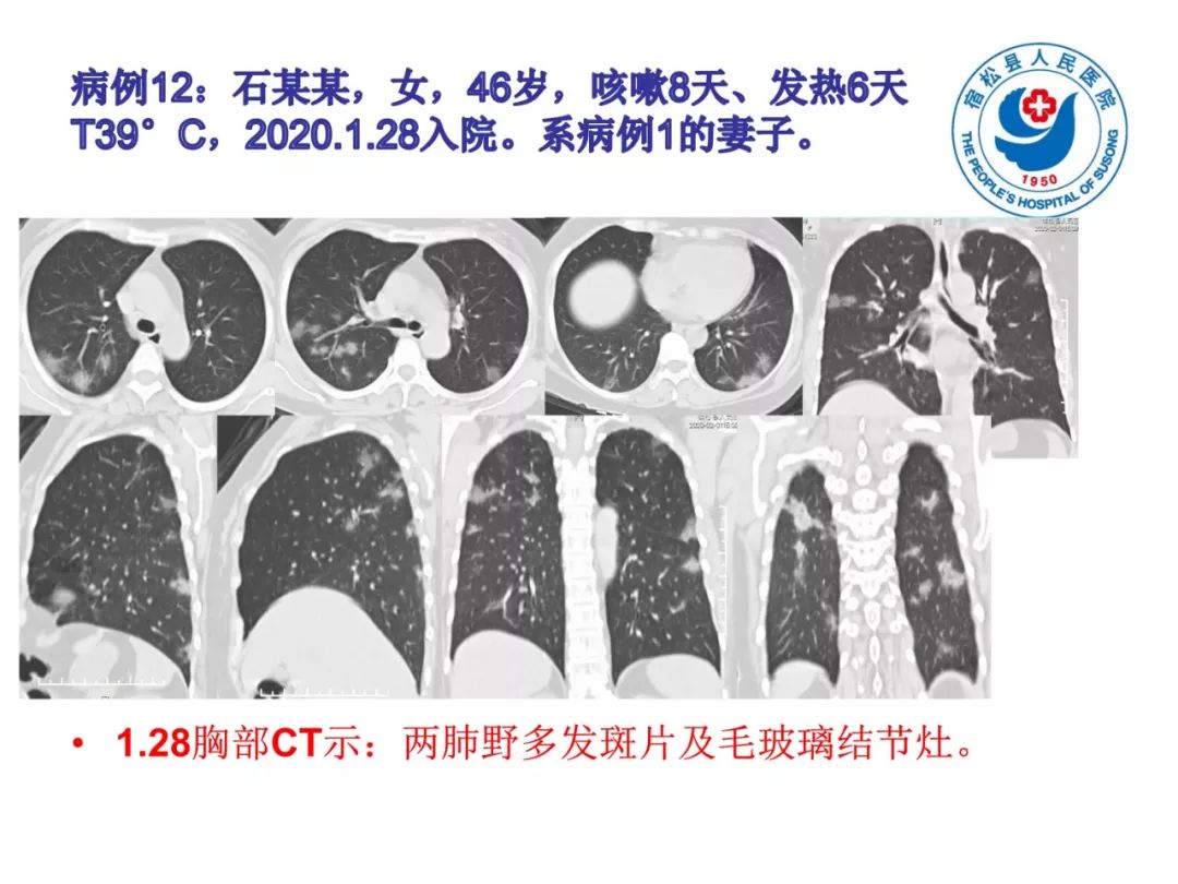 【PPT】(来自一个县医院的12例)我院新型冠状病毒肺炎特点