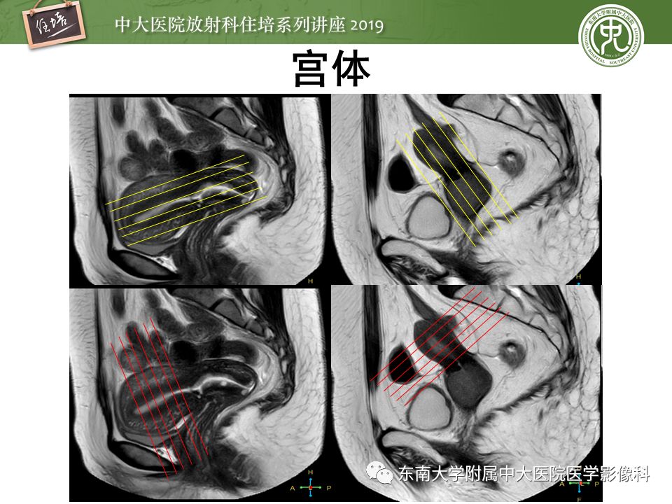 【PPT】子宫影像解剖及相关MR信号分析