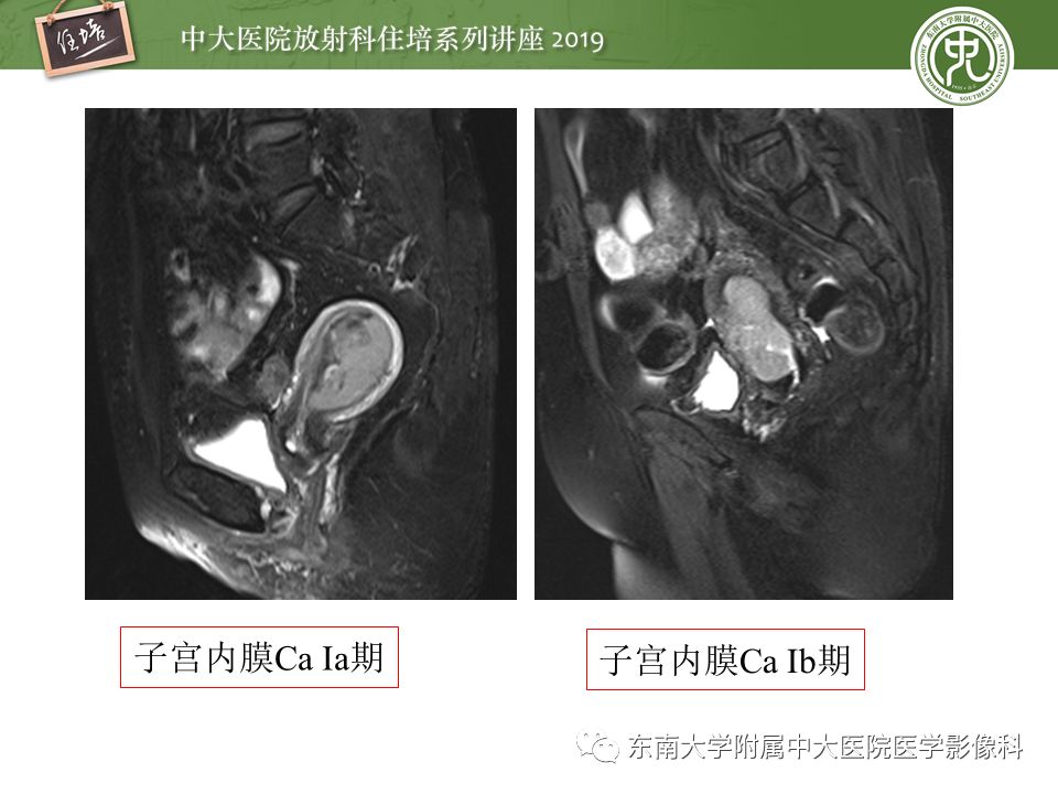 【PPT】子宫影像解剖及相关MR信号分析