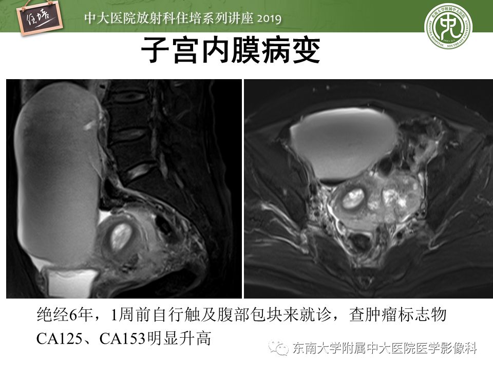 【PPT】子宫影像解剖及相关MR信号分析