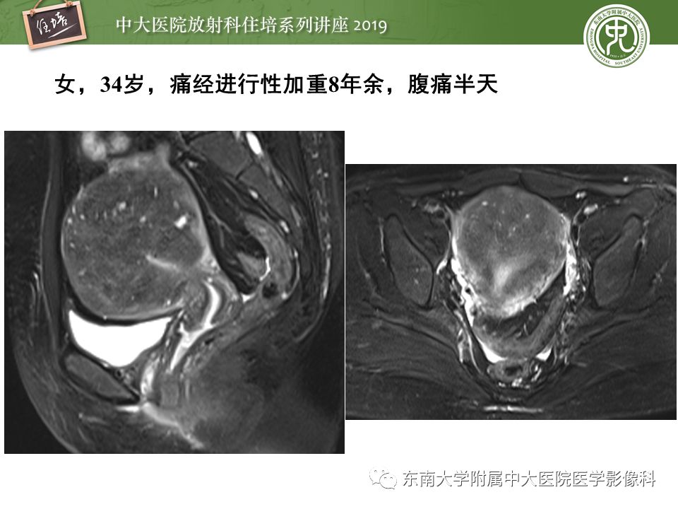 【PPT】子宫影像解剖及相关MR信号分析