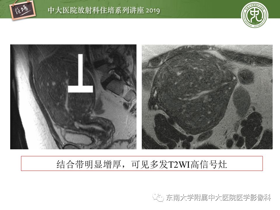 【PPT】子宫影像解剖及相关MR信号分析