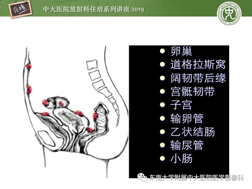 【PPT】子宫影像解剖及相关MR信号分析