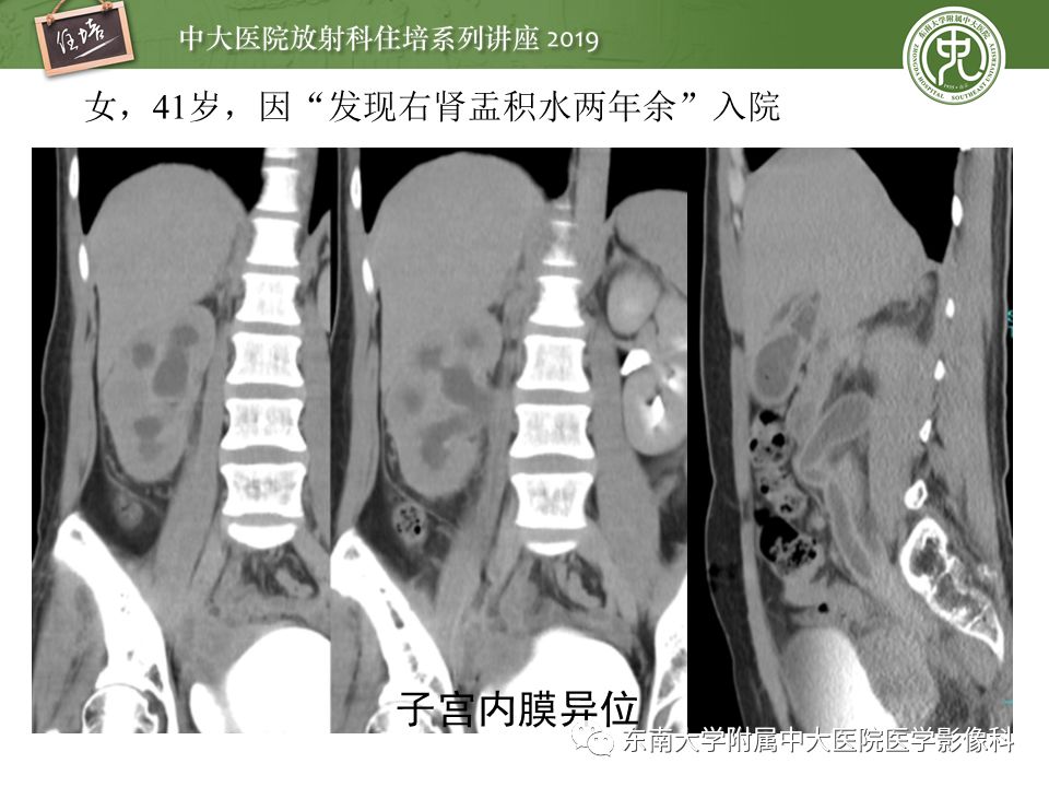 【PPT】子宫影像解剖及相关MR信号分析