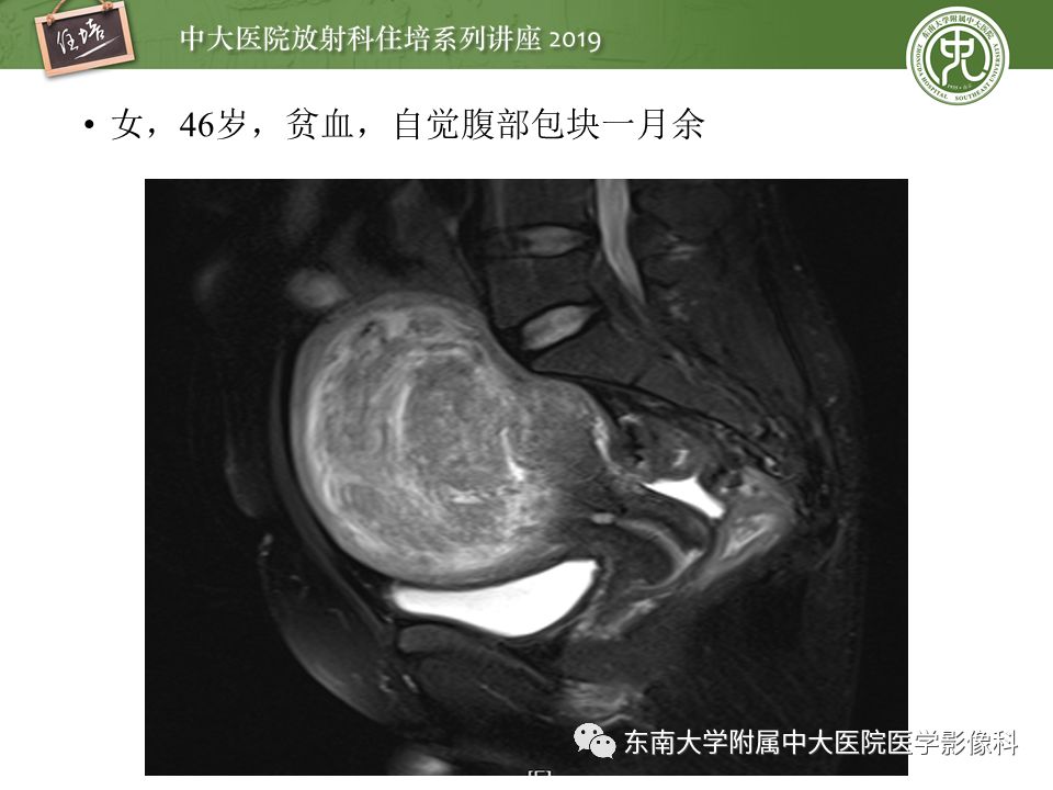 【PPT】子宫影像解剖及相关MR信号分析