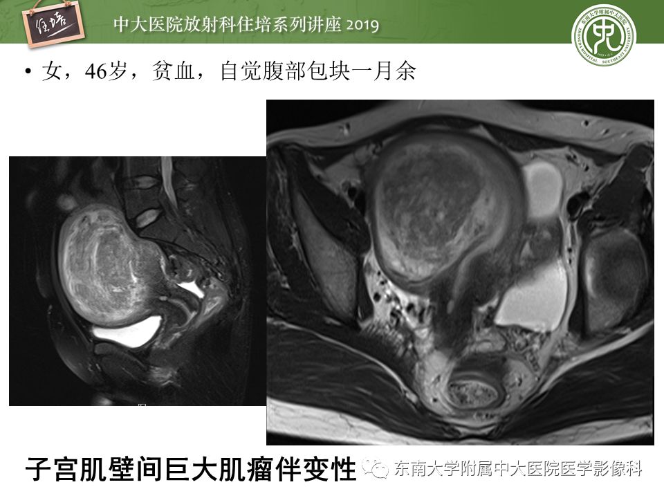 【PPT】子宫影像解剖及相关MR信号分析