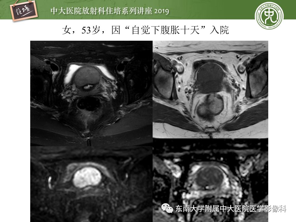 【PPT】子宫影像解剖及相关MR信号分析