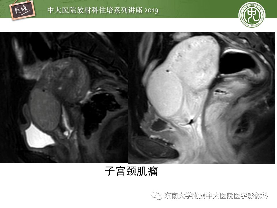 【PPT】子宫影像解剖及相关MR信号分析