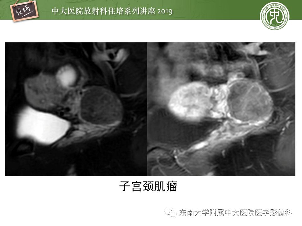 【PPT】子宫影像解剖及相关MR信号分析