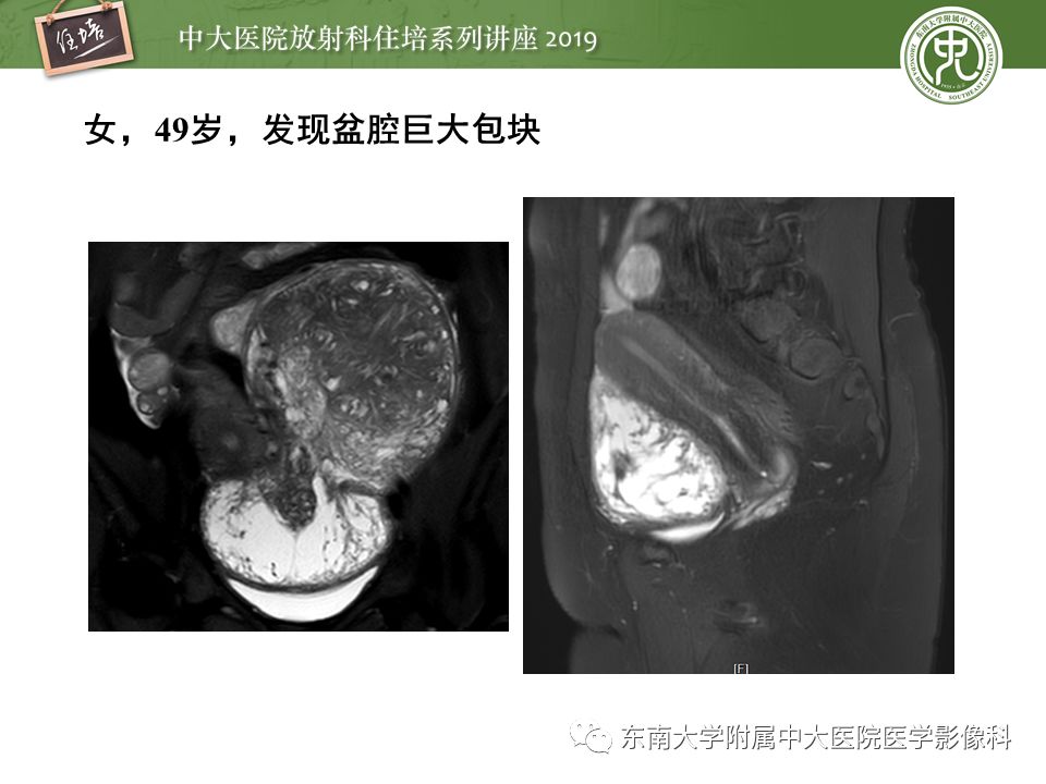 【PPT】子宫影像解剖及相关MR信号分析