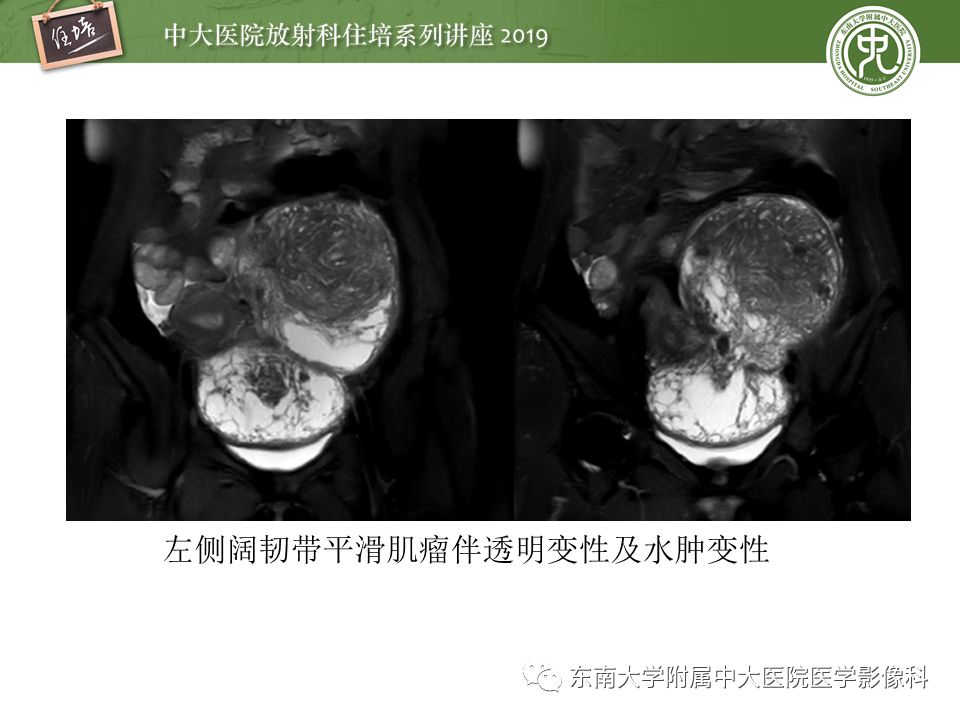 【PPT】子宫影像解剖及相关MR信号分析
