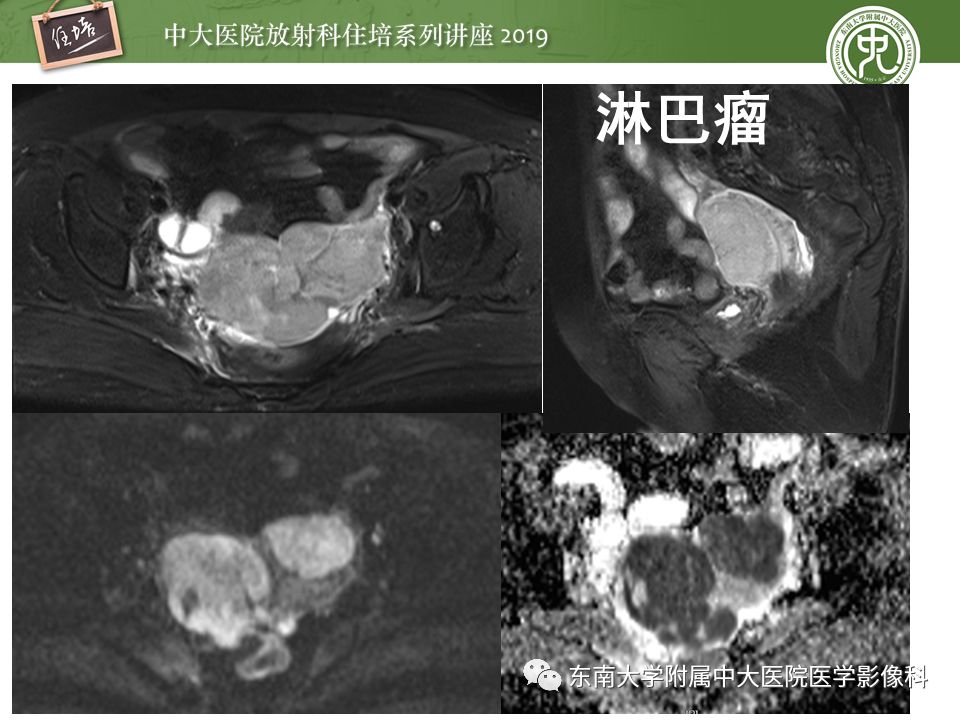 【PPT】子宫影像解剖及相关MR信号分析