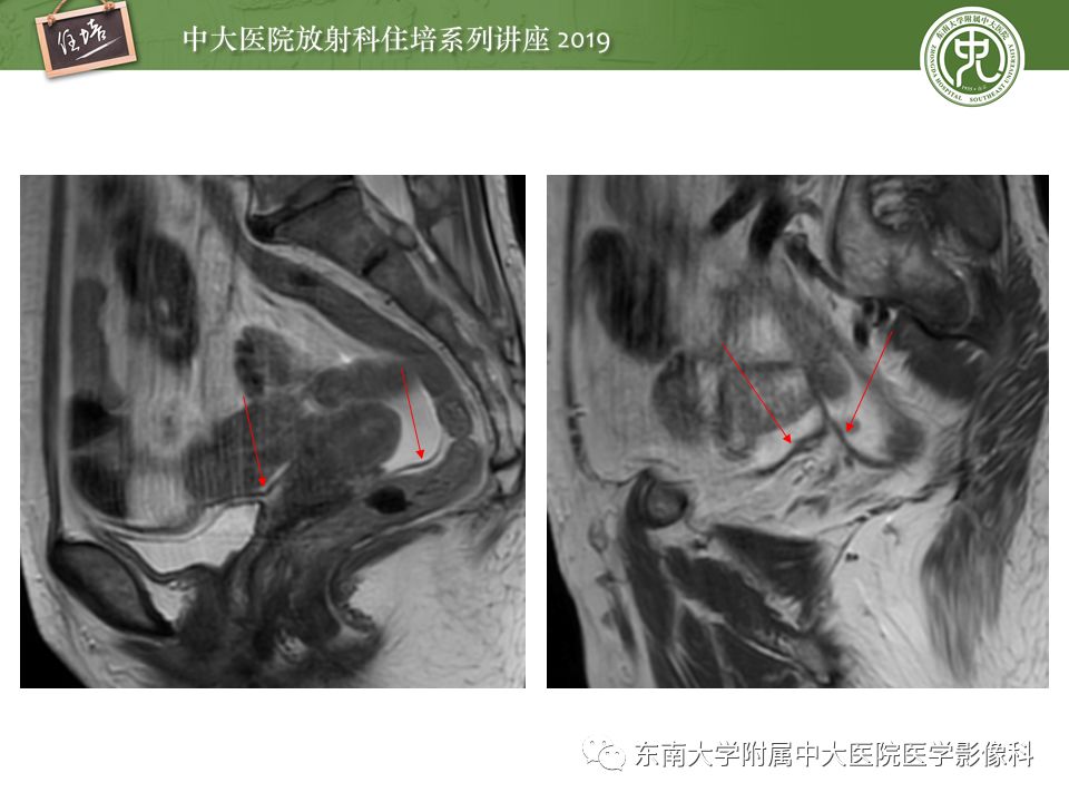 【PPT】子宫影像解剖及相关MR信号分析