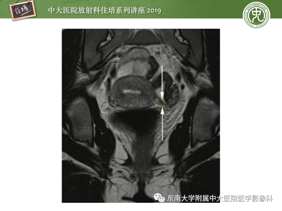 【PPT】子宫影像解剖及相关MR信号分析