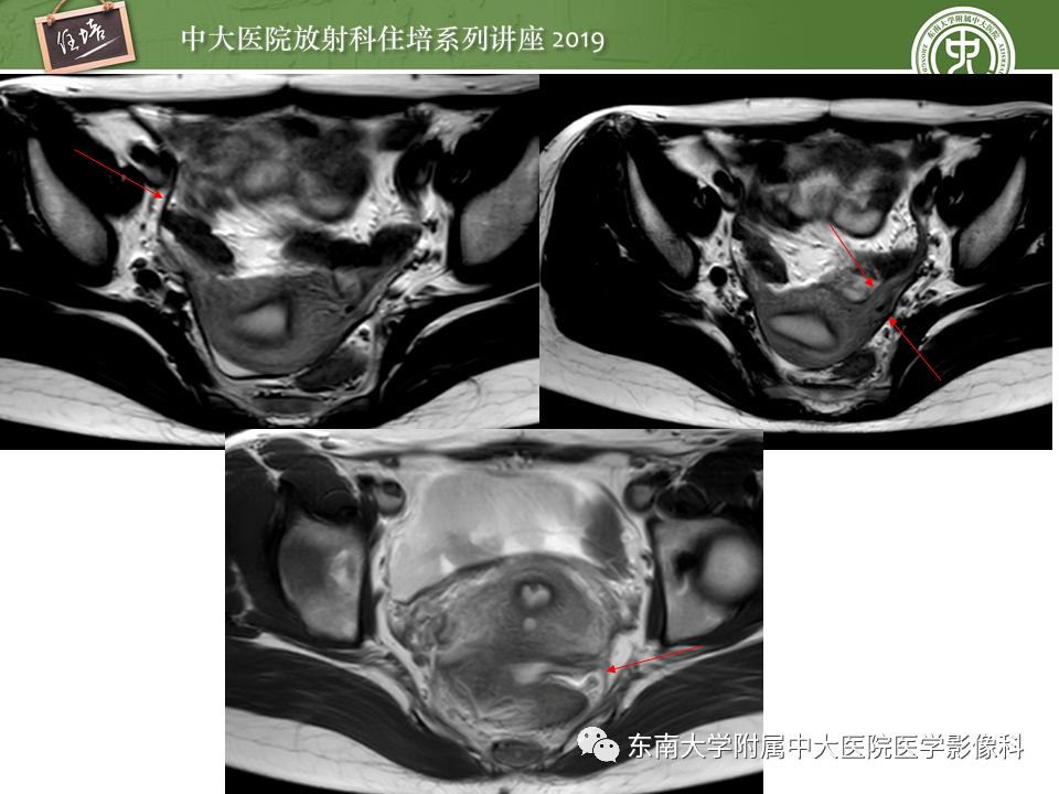 【PPT】子宫影像解剖及相关MR信号分析