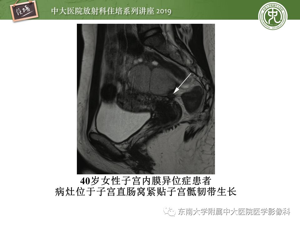 【PPT】子宫影像解剖及相关MR信号分析