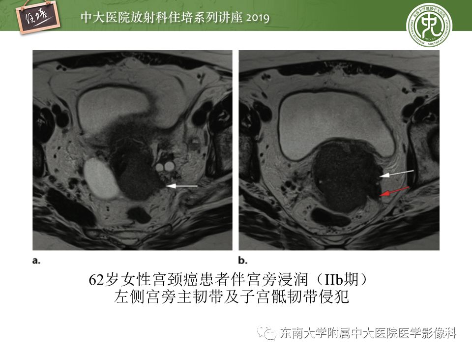 【PPT】子宫影像解剖及相关MR信号分析