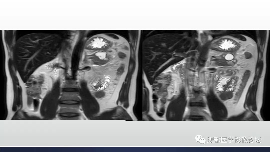 【病例】胰腺尾部假性囊肿伴出血1例CT及MR