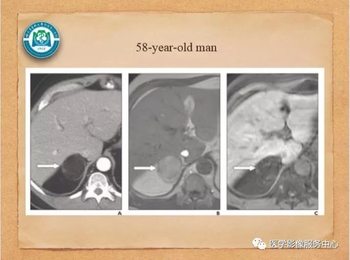【PPT】肾上腺结节的CT和MRI诊断—肾上腺结节诊断三板斧