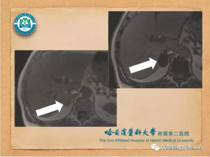 【PPT】肾上腺结节的CT和MRI诊断—肾上腺结节诊断三板斧