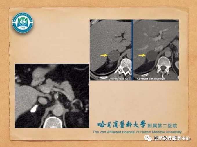 【PPT】肾上腺结节的CT和MRI诊断—肾上腺结节诊断三板斧