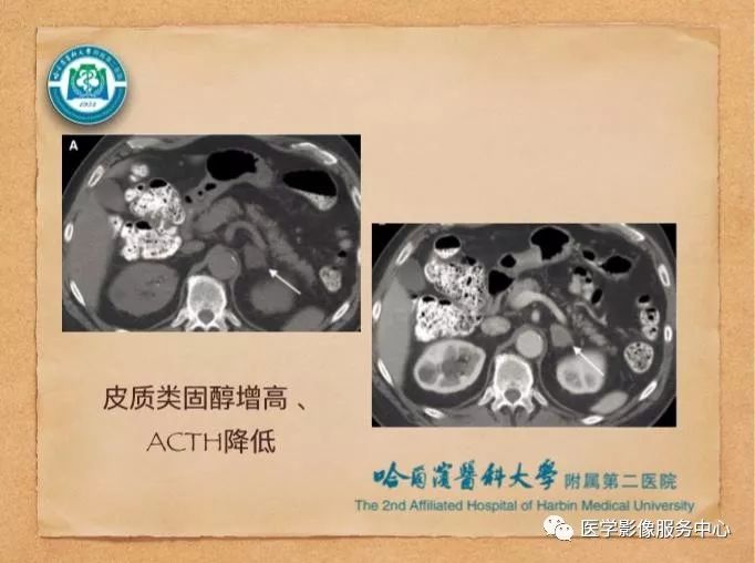【PPT】肾上腺结节的CT和MRI诊断—肾上腺结节诊断三板斧