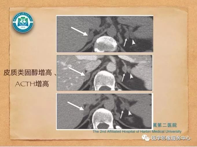 【PPT】肾上腺结节的CT和MRI诊断—肾上腺结节诊断三板斧