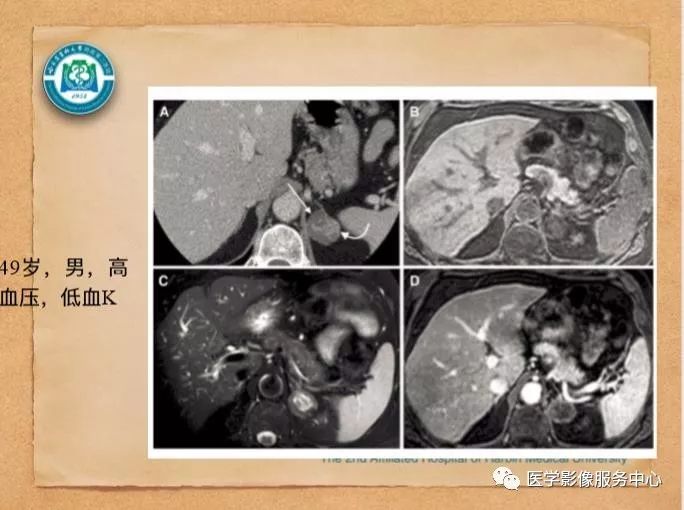 【PPT】肾上腺结节的CT和MRI诊断—肾上腺结节诊断三板斧