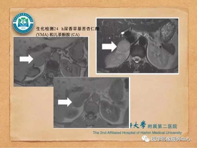 【PPT】肾上腺结节的CT和MRI诊断—肾上腺结节诊断三板斧