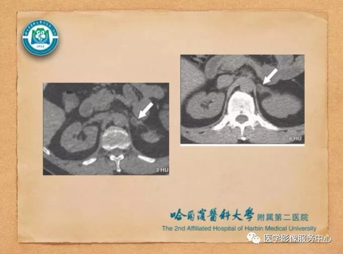 【PPT】肾上腺结节的CT和MRI诊断—肾上腺结节诊断三板斧