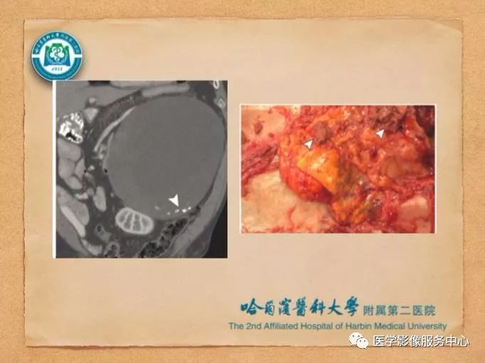 【PPT】肾上腺结节的CT和MRI诊断—肾上腺结节诊断三板斧