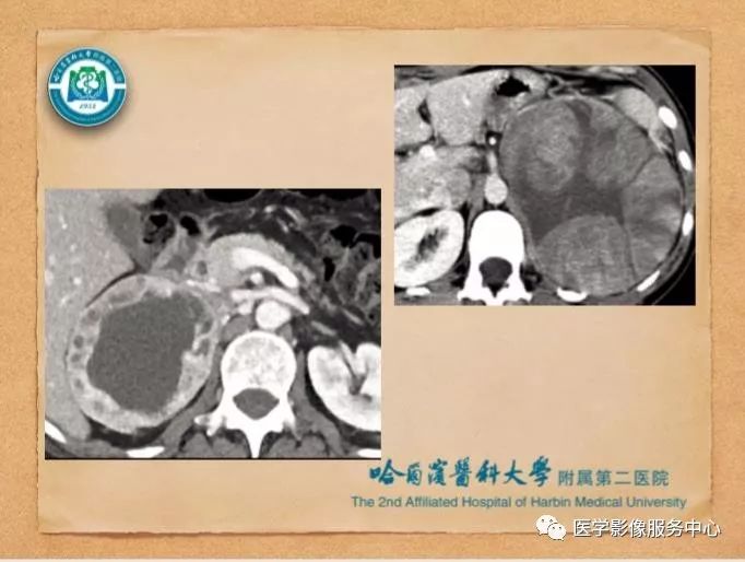 【PPT】肾上腺结节的CT和MRI诊断—肾上腺结节诊断三板斧