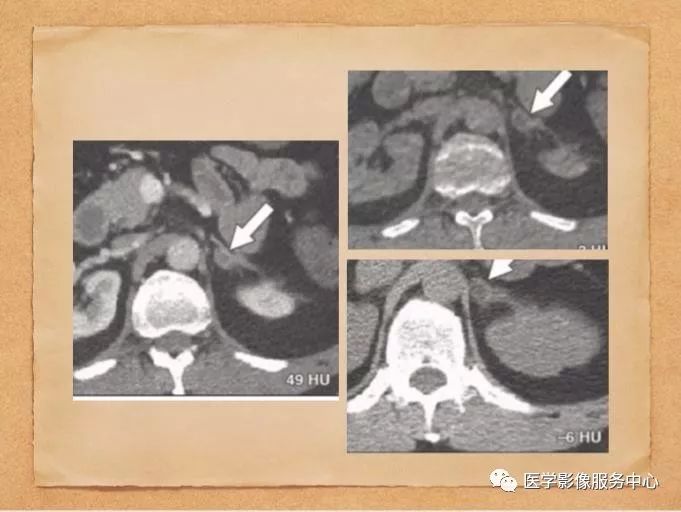 【PPT】肾上腺结节的CT和MRI诊断—肾上腺结节诊断三板斧