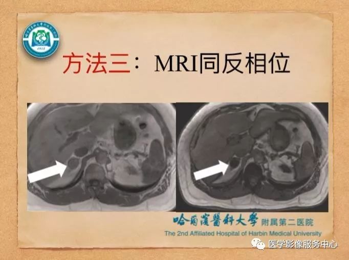 【PPT】肾上腺结节的CT和MRI诊断—肾上腺结节诊断三板斧
