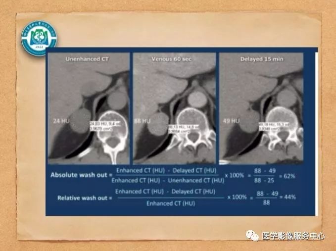 【PPT】肾上腺结节的CT和MRI诊断—肾上腺结节诊断三板斧