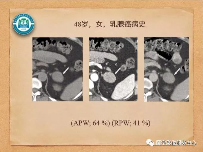 【PPT】肾上腺结节的CT和MRI诊断—肾上腺结节诊断三板斧