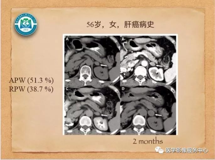 【PPT】肾上腺结节的CT和MRI诊断—肾上腺结节诊断三板斧