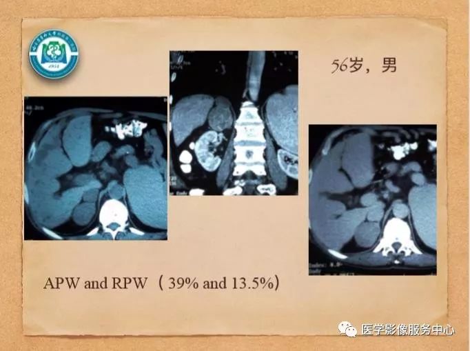 【PPT】肾上腺结节的CT和MRI诊断—肾上腺结节诊断三板斧