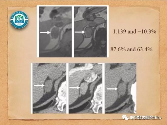 【PPT】肾上腺结节的CT和MRI诊断—肾上腺结节诊断三板斧