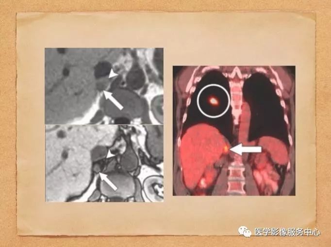 【PPT】肾上腺结节的CT和MRI诊断—肾上腺结节诊断三板斧
