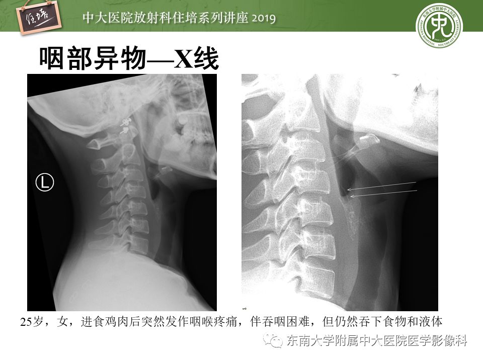 【PPT】口咽部异物及感染性病变的影像诊断
