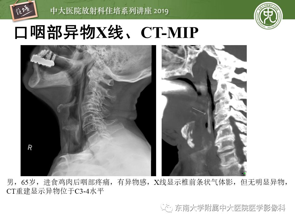 【PPT】口咽部异物及感染性病变的影像诊断