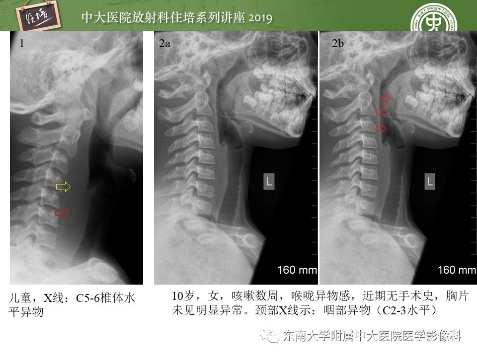 【PPT】口咽部异物及感染性病变的影像诊断